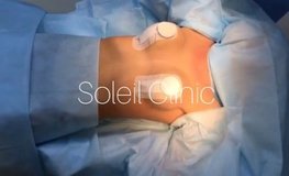 Видео результата подтяжки тканей молочных желёз