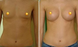 Фото до и после увеличения груди из подмышечного доступа имплантатами объемом 405 мл