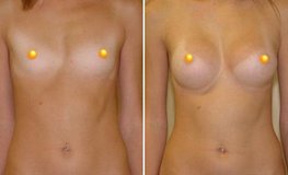 Фото до и после увеличения груди имплантатами объемом 325 мл из подмышечного доступа