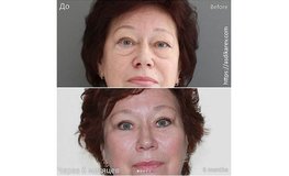 Фото до и после операции Олирави и подтяжки лица
