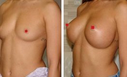 Фото до и после эндоскопического увеличения груди из подмышки