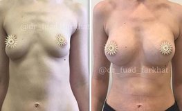 Фото до и после увеличения груди имплантатами объемом 335 через ареолу