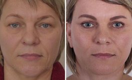 Фото до и после комплексного омоложения лица и шеи