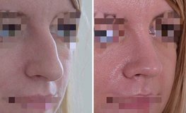 Фото до и после атравматичной методики риноскульптуры носа