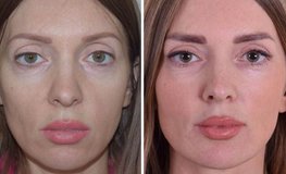Фото до и после подтяжки средней зоны лица и липофилинга век