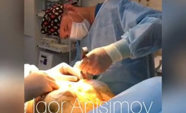 Видео результата аугментационной пластики груди