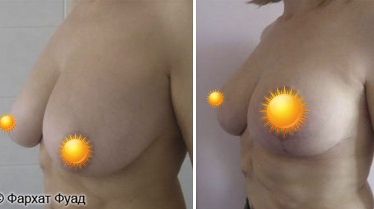 Результаты пластики по уменьшению размера груди, пациентка 36 лет, пластический хирург Фархат Фуад Ахмедович