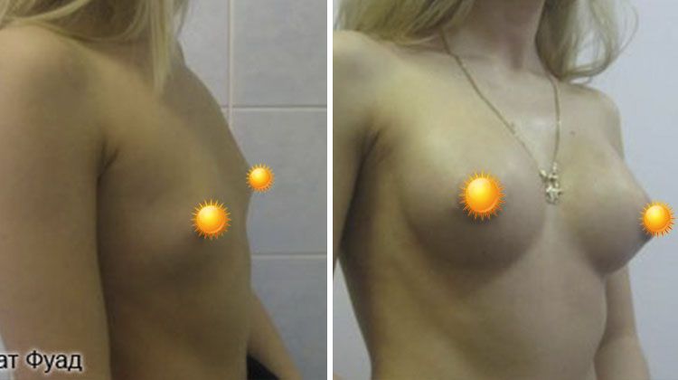 Эндопротезирование груди имплантатами объемом 190 мл, нерожавшая пациентка 24 года, пластический хирург Фархат Фуад Ахмедович