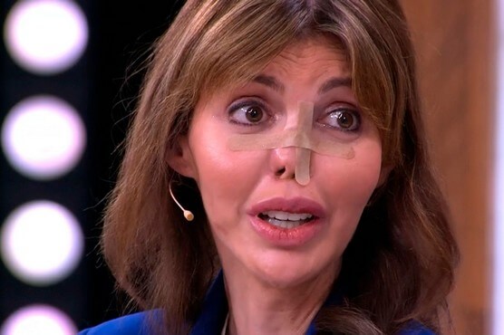 Бывшая жена Андрея Аршавина начала сложный путь по восстановлению носа