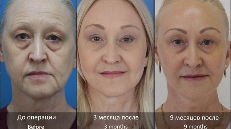 Результаты бесплатной полной подтяжки лица на мастер-классе, пластический хирург Дикарев Алексей Сергеевич