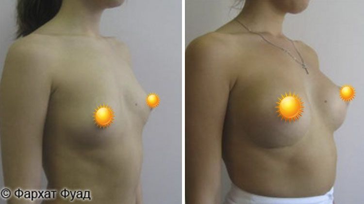 Маммопластика грудными имплантатами анатомической формы, пациентка 20 лет, пластический хирург Фархат Фуад Ахмедович