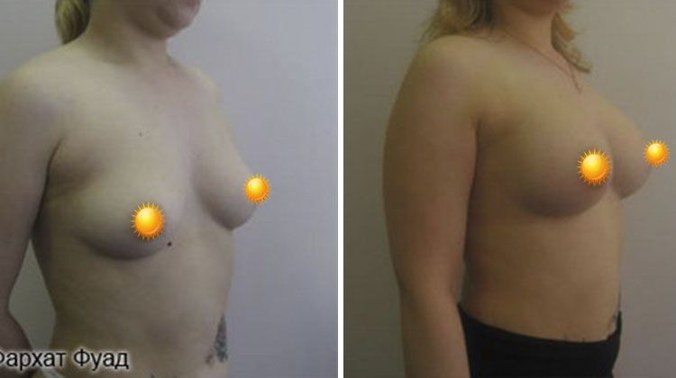 Эндопротезирование грудными имплантатами объемом 310 мл, пациентка 31 года, пластический хирург Фархат Фуад Ахмедович
