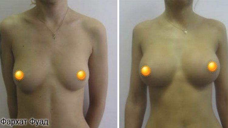 Пластика грудными имплантатами объема 280 мл, пациентка 24 года, пластический хирург Фархат Фуад Ахмедович
