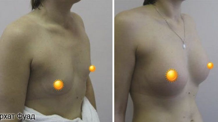 Результаты увеличения груди имплантатами объемом 340 мл, пациентка 27 лет, пластический хирург Фархат Фуад Ахмедович