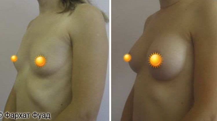 Результаты увеличения груди имплантатами объемом 205 мл анатомической формы, пластический хирург Фархат Фуад Ахмедович