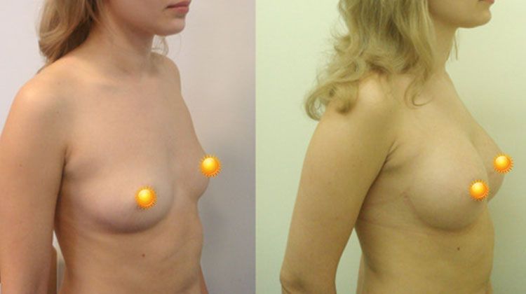 Увеличение грудных желез при помощи имплантата, введенного через субмаммарную складку, пластический хирург Фархат Фуад Ахмедович