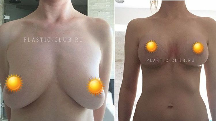История пациентки, дважды прошедшей операцию по увеличению груди, пластический хирург Фото до и после маммопластики с последующей коррекцией