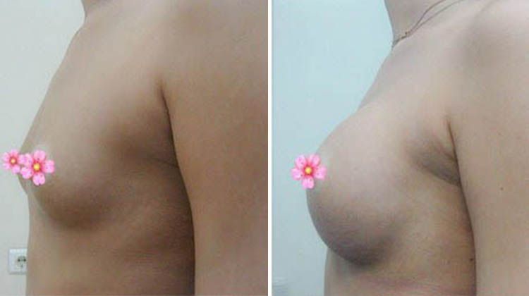 Коррекция формы груди силиконовыми имплантатами, пластический хирург Анисимов Игорь Дмитриевич