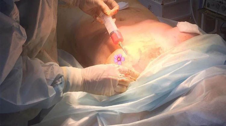 Липофилинг груди с предшествующей липосакцией, пластический хирург Демин Сергей Анатольевич