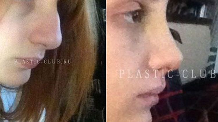 Отзыв пациентки о результатах ринопластики, пластический хирург Фото до и после ринопластики