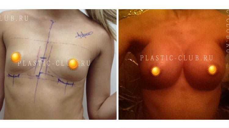 Результаты увеличения груди имплантатами разрезом под грудью, пациентка 24 года, пластический хирург Фархат Фуад Ахмедович