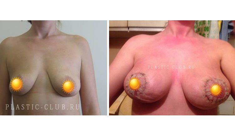 Результаты операции по увеличению груди и устранению выраженной асимметрии, пластический хирург Фархат Фуад Ахмедович