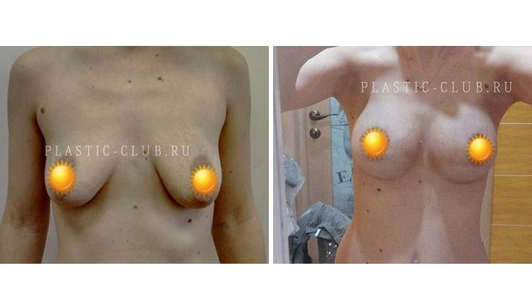 Исходное состояние и изменения формы и размера груди в динамике, пластический хирург Фархат Фуад Ахмедович