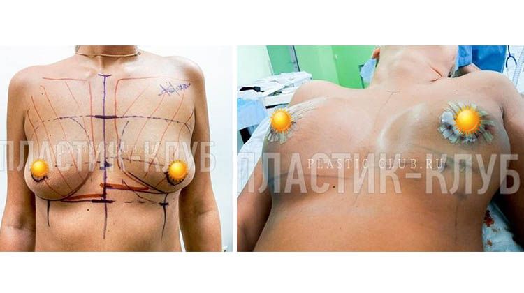 Результаты подтяжки и увеличения груди у рожавшей пациентки, пластический хирург Фархат Фуад Ахмедович
