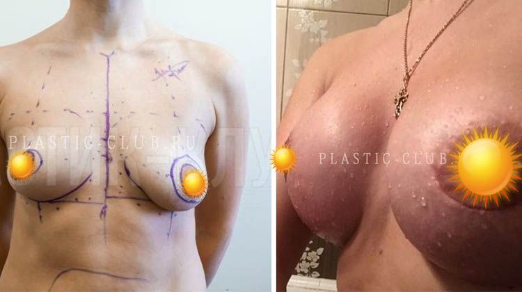 Отзыв с фотографиями до и после эндопротезирования имплантатами разного размера, пластический хирург Фархат Фуад Ахмедович