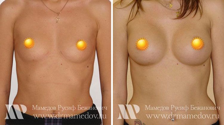 Результаты маммопластики (увеличение груди) круглыми имплантатами, нерожавшая пациентка, пластический хирург Мамедов Русиф Бежанович