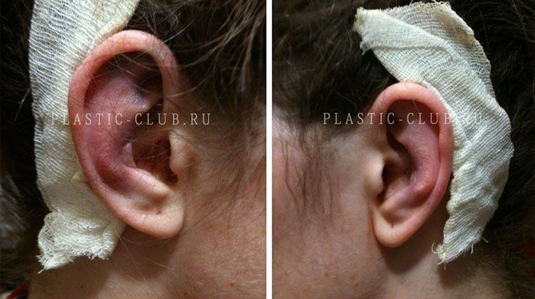 История после двусторонней коррекции ушей скальпелем, пациентка 25 лет, пластический хирург Фото после отопластики