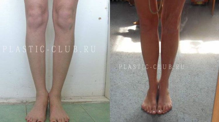 История девушки после пластики голени, пластический хирург Фото до и после пластики голени
