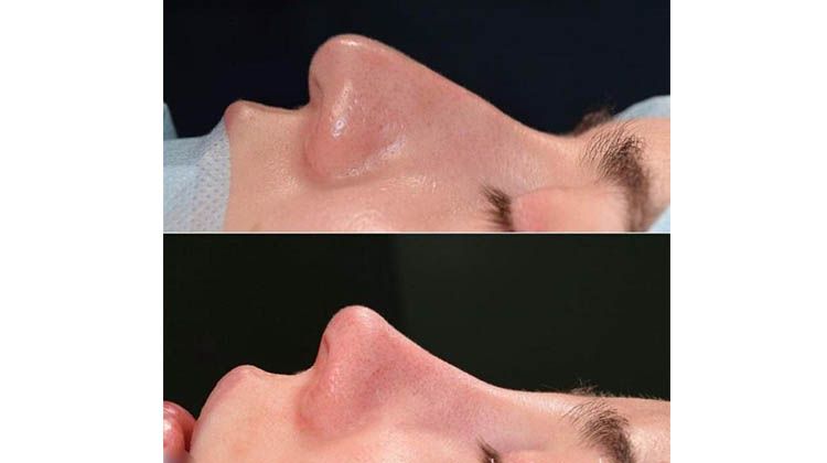 Исходное состояние и изменения формы носа после риноскульптуры, пластический хирург Мамедов Русиф Бежанович