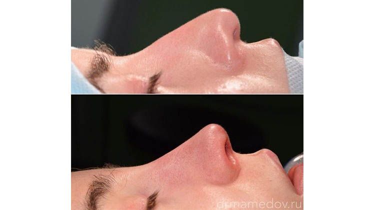 Результат изменений носа при использовании методики динамичная риноскульптура, пластический хирург Мамедов Русиф Бежанович