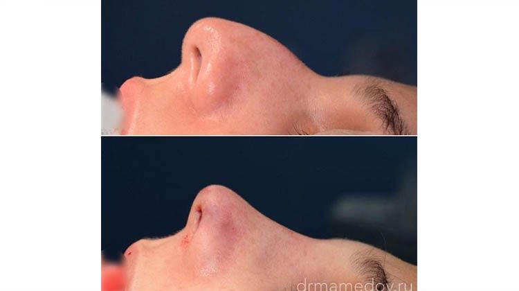Результат динамичной риноскульптуры (удаление горбинки носа), пластический хирург Мамедов Русиф Бежанович