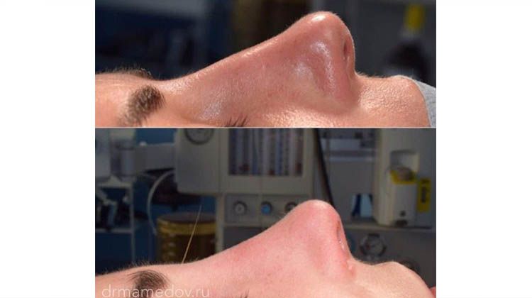 Пациентка до и после ринопластики на операционном столе, пластический хирург Мамедов Русиф Бежанович