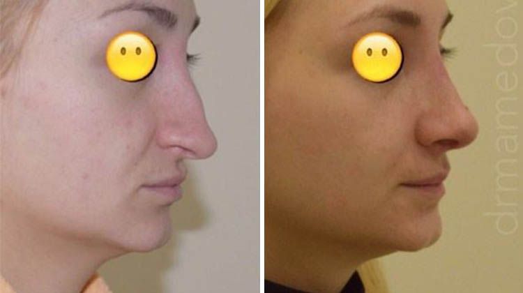 Результат успешной риносентопластики травмированного носа, пластический хирург Мамедов Русиф Бежанович
