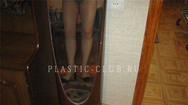 Отчет о пластике голени, пластический хирург Фото после пластики голени
