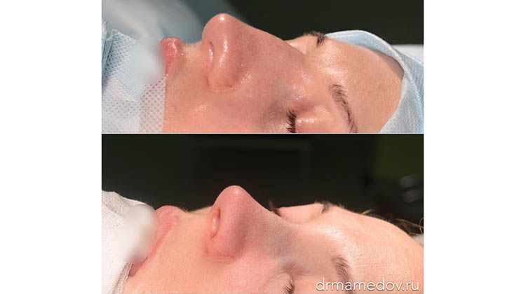 Результаты успешной операции динамичная риноскульптура носа, пластический хирург Мамедов Русиф Бежанович