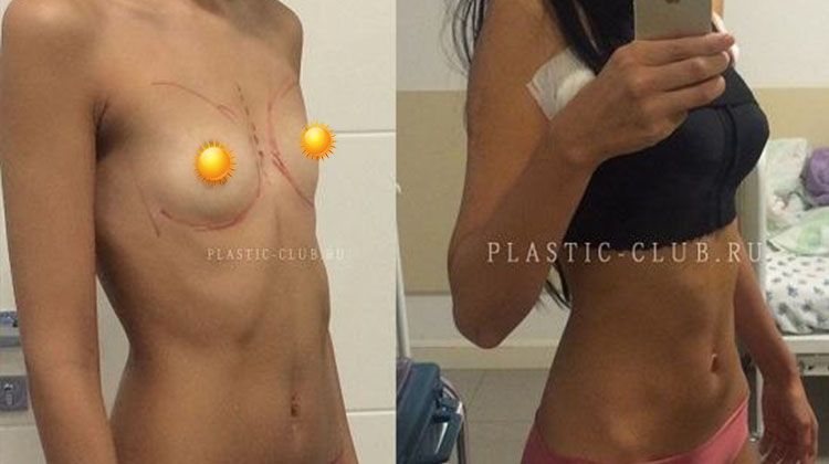 Фотографии до и после операции по увеличения груди анатомическими имплантатами объемом 320 мл, пластический хирург Фото до и после увеличивающей маммопластики имплантатами объемом 320 мл
