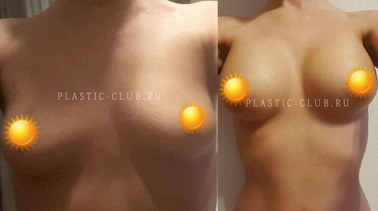 Фотоотчет пациентки после увеличения груди объемом имплантатов 335 мл для левой и 320 мл для правой, пластический хирург Фото до и после маммопластики для ассиметричной груди