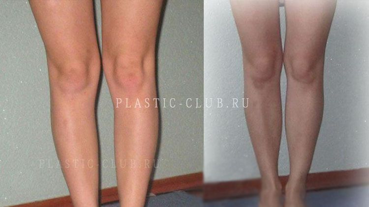 Рассказ пациентки о пластике голени, пластический хирург Фото до и после пластики голени