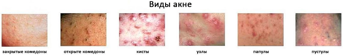 Виды акне