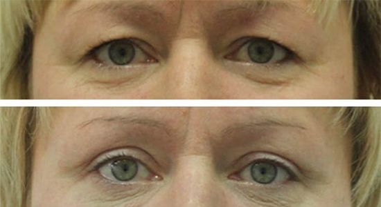 Круговая блефаропалстика