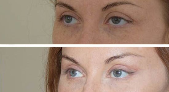 Верхняя блефаропластика и кантопексия