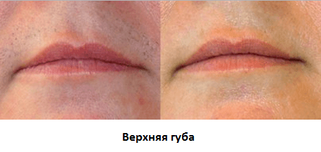 Фото до и после эпиляции