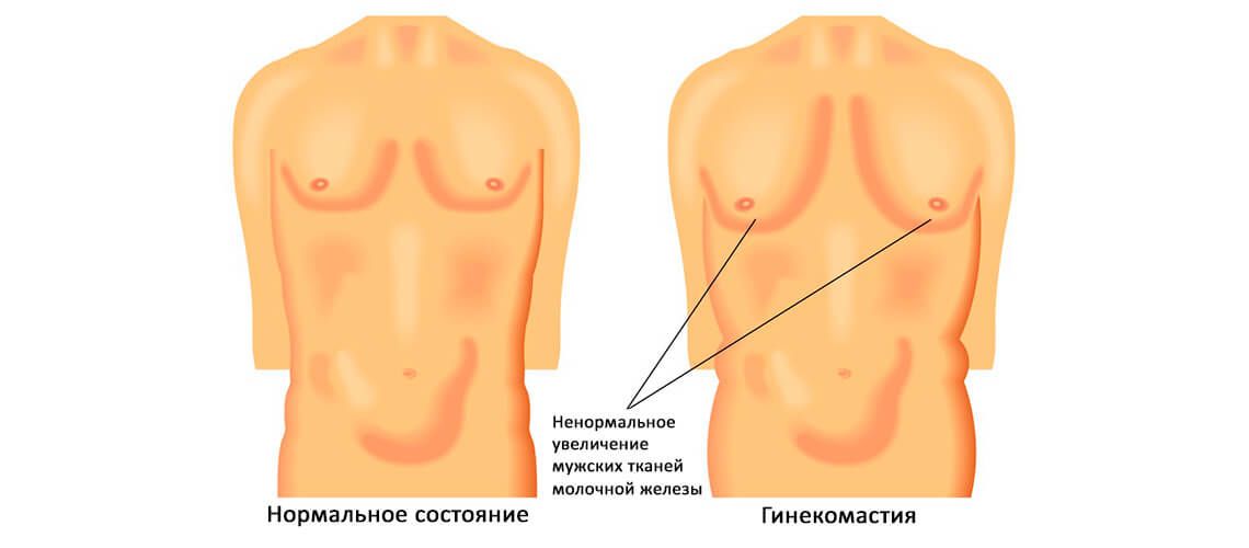 Нормальные молочные железы и с проявление глинекомастии