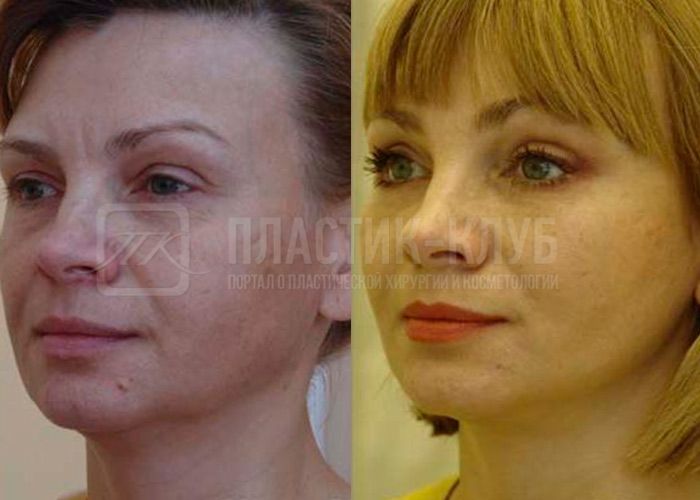 Фото до и после SMAS — лифтинга
