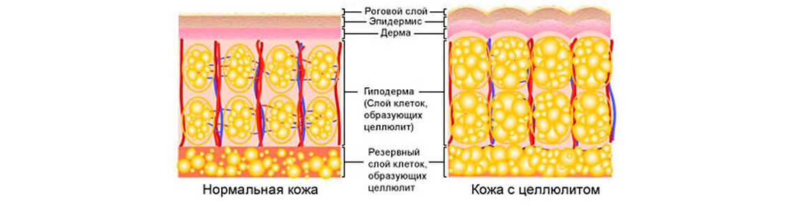 Нормальная кожа и кожа с целлюлитом