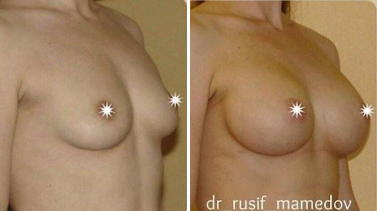 эндопротезирования молочных желез имплантатами компании «Ментор»